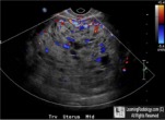 molar pregnancy mole